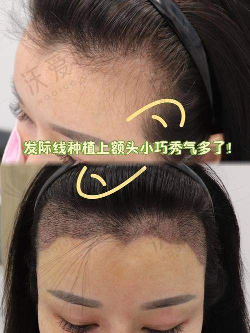 天津微创植发医院排行-天津大麦微针植发行业领跑实力强
