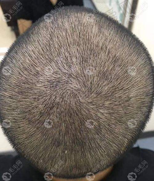 天津微创植发医院排行-天津鑫伊颂整形美容诊所贴心服务有特色