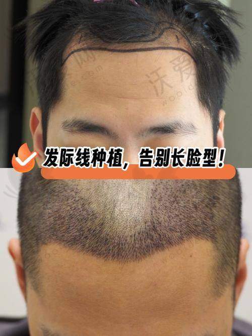 2025天津微创植发医院排行上新！熙朵、雍禾、长征医院上榜前三十家医院各展风采