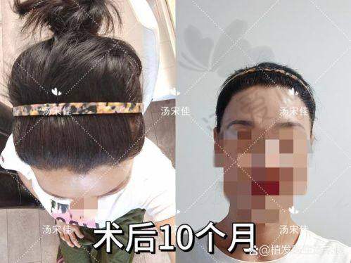 天津微创植发医院排行-天津伊美尔瑞丽诗植发技术专精方案多