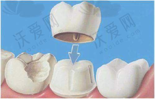 湛江柏乐口腔医院爱尔创全瓷牙是什么材料？