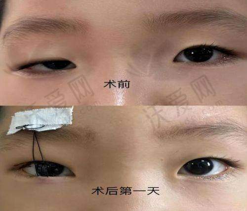 上海爱尚丽格医疗美容上睑松弛矫正显著的作用和成效