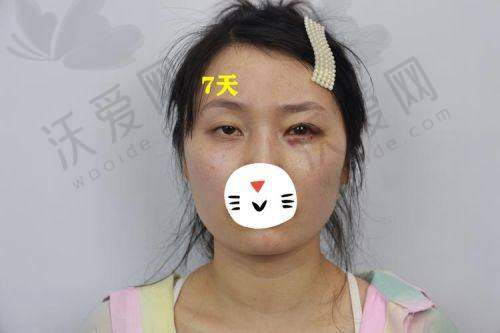 上海爱尚丽格医疗美容上睑松弛矫正，优质的服务体验