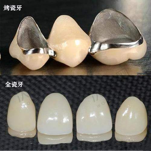 湛江柏乐口腔医院爱尔创全瓷牙1580元起一颗，多优势打造健康美观好牙