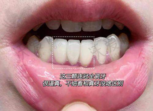 湛江柏乐口腔医院爱尔创全瓷牙适合哪些人？