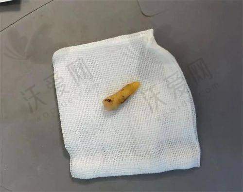 北京八大处整形医院：异物取出实力派