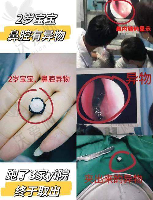 北京艾玛医疗美容：深层异物取出好帮手