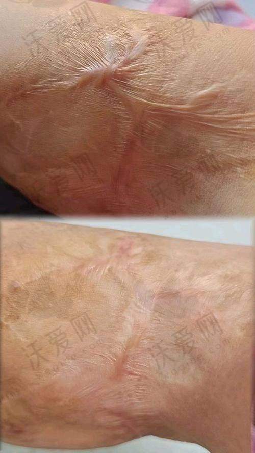 上海虹桥医院增生疤痕修复原价6500元起，现仅1080元起享安心祛疤！