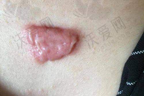 上海虹桥医院疤痕科其他同类项目收费标准参考