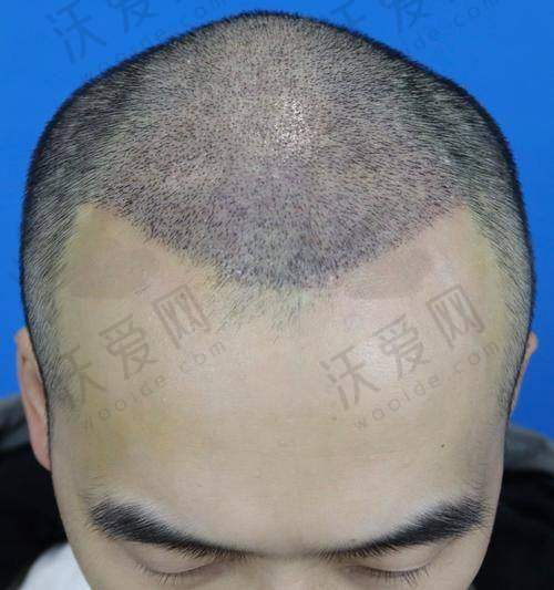 医学美容医院——植发成效较好的综合医院