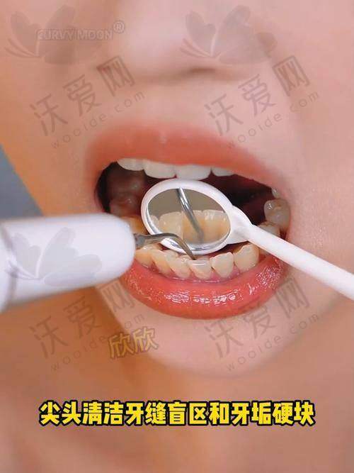 湛江柏乐口腔成人洁牙+抛光套餐108元起，享安全舒适个性化口腔清洁体验