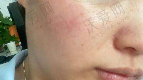 成都素美AOPT淡化红血丝全模式原价1000元，现396元起，自采可验真
