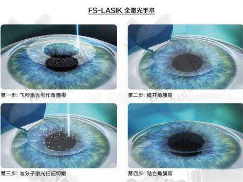 昆明艾维眼科在远视储备检查方面的实力如何？