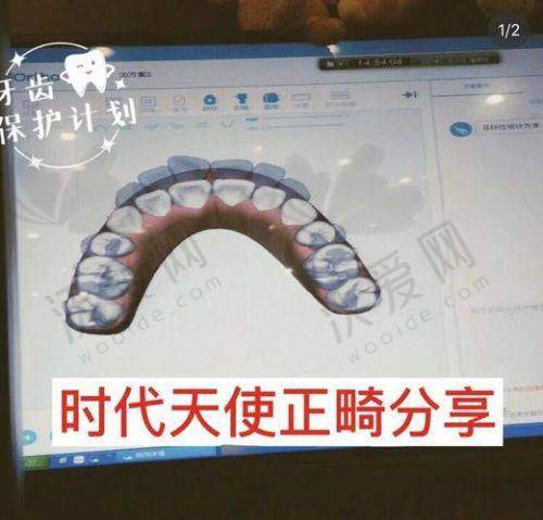 徐州美奥口腔时代天使隐形矫正原价25888元起，折后1.5万起矫正牙齿畸形超靠谱