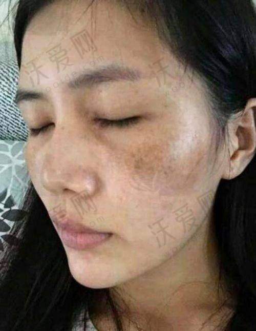 成都素美PicoWay超皮秒全模式淡化黑眼圈医院的正规可靠性