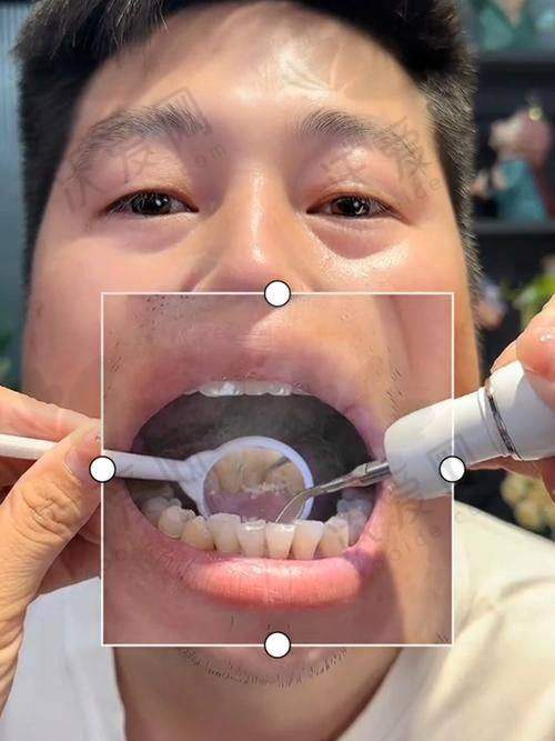 东莞好佰年口腔纳米喷砂深度洁牙的作用与成效