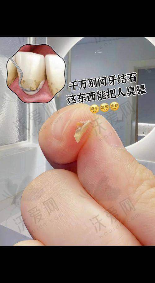 东莞好佰年口腔纳米喷砂深度洁牙原价910元，现仅118元起速享牙齿洁净！