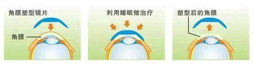 昆明艾维眼科成人1.553非球面医学配镜能带来什么成效？
