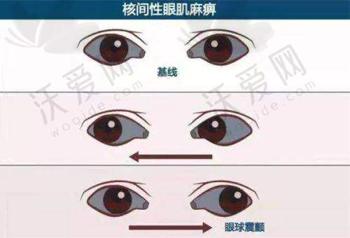昆明艾维眼科在成人1.553非球面医学配镜方面实力如何？