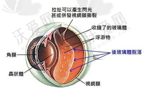 郑州爱尔眼科TICL晶体植入手术单眼原价36500元，现19300元起晶体可逆视觉优