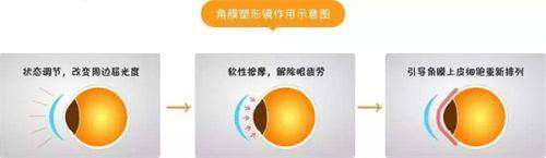 广州视百年眼科蔡司4.0全飞秒近视手术的技术优势有哪些呢？