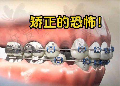 长沙戴牙套矫正价格大概多少钱呢？低价且技术好的牙科医院排名及价目表看这里