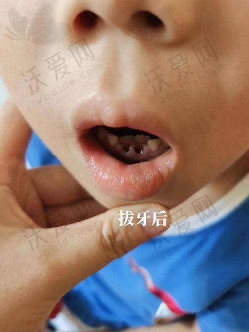 成都医大口腔医院儿童乳牙松动牙拔除88元起，多优势护航孩子换牙无忧！