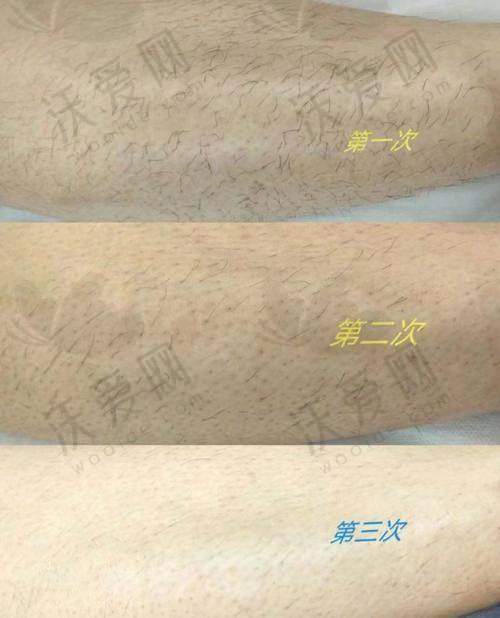 武汉真爱私密整形比基尼冰点脱毛需要做几次才有成效？