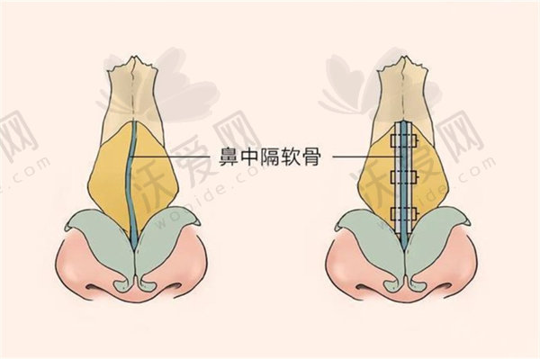 长沙雅美田芳斌预约挂号攻略给你！鼻眼修复及初眼整形效果超惊艳