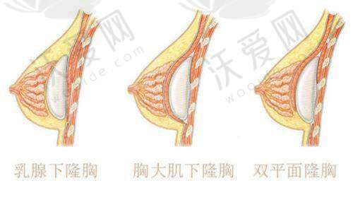杭州美莱医疗美容医院黄剑媚医生技术好不好？