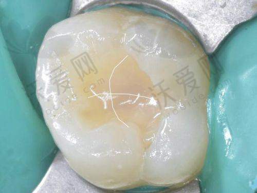 成都医大口腔美国登士柏树脂补牙适用情况
