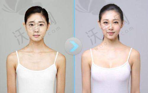 北京美莱医疗美容医院高超医生口碑评价如何？