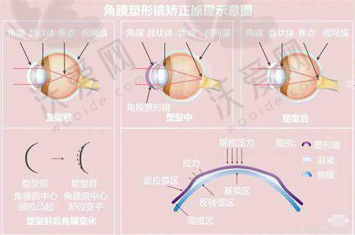 苏州光明眼科医院胡正再院长口碑怎么样？