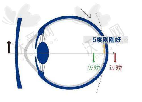保定新视眼科李月平医生白内障蔡司三焦晶体植入23800元起，清晰视界一步到位畅享无忧生活