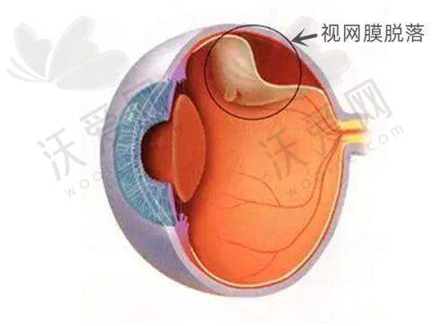 河南省人民医院眼科的激光手术价格