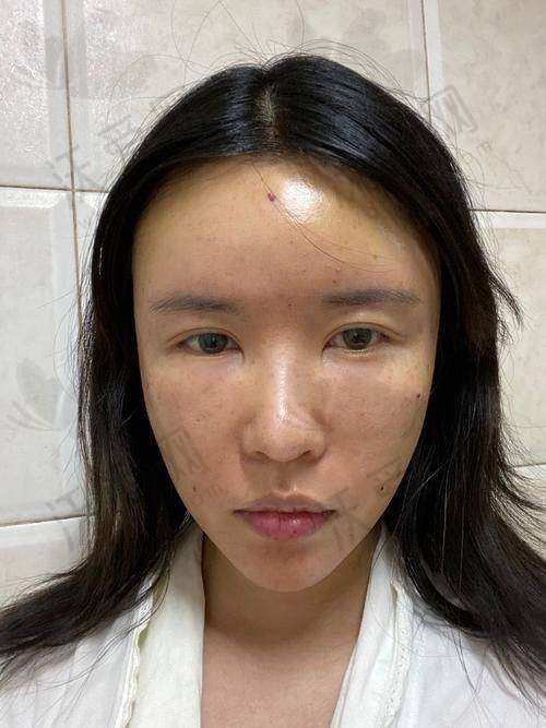 北京美莱医疗美容医院田鹏医生技术好不好？