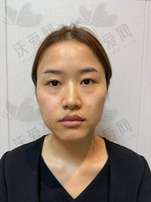 深圳阳光整形瑞蓝唯瑅长效玻尿酸水光的技术有哪些优势？