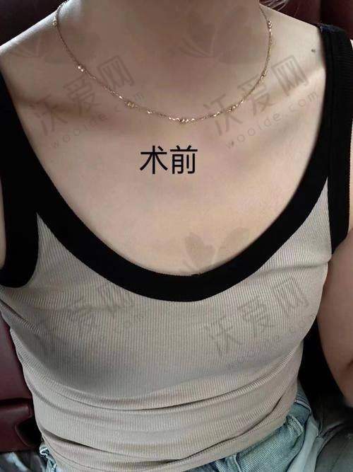 深圳阳光整形医院自体脂肪隆胸价格是多少？