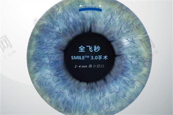 赣州爱尔眼科小创口全飞秒4.0-Visulyze手术18800元起，刘伟医生助力告别近视轻松无忧