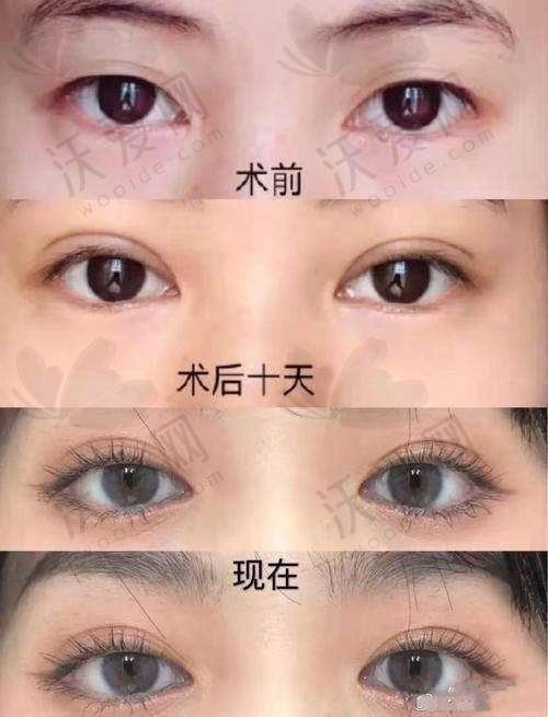 深圳阳光整形切开双眼皮+去皮去脂的技术优势