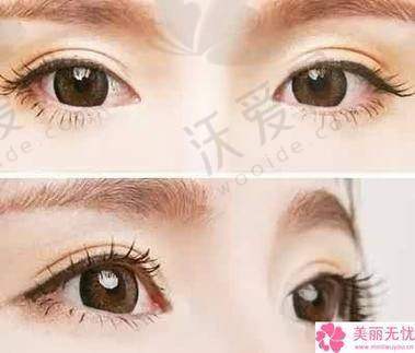 深圳阳光整形切开双眼皮+去皮去脂原价7658元，如今4980元起开启美眼惊喜!