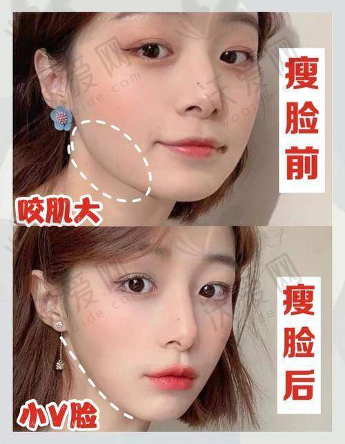王阔远医生面部减容技术好收费1.5W起，沟通顺畅达期望