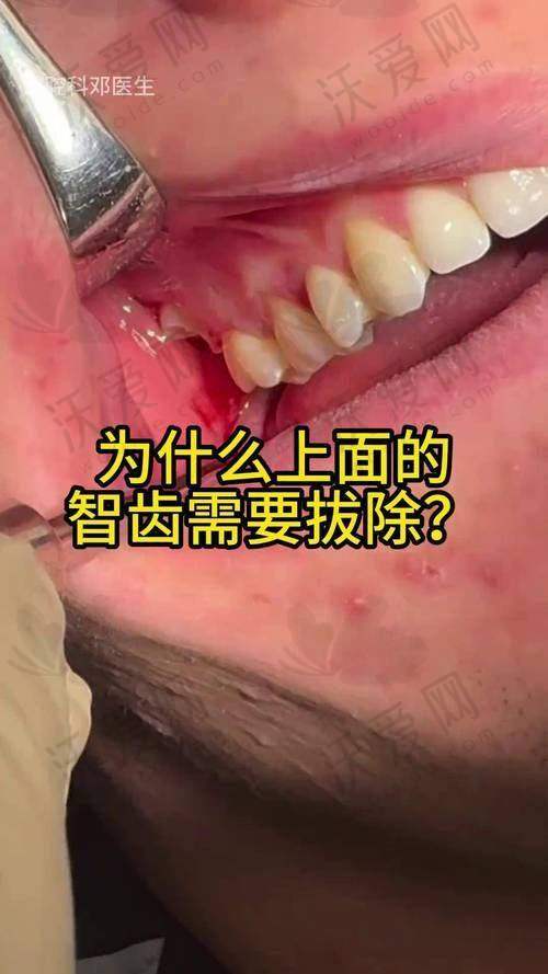 南通美奥口腔医院拔智齿采用精良微创技术