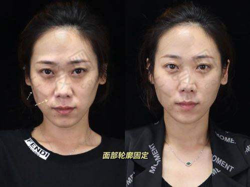 北京蒂凡妮医疗美容门诊部王志坚医生之三点无痕术