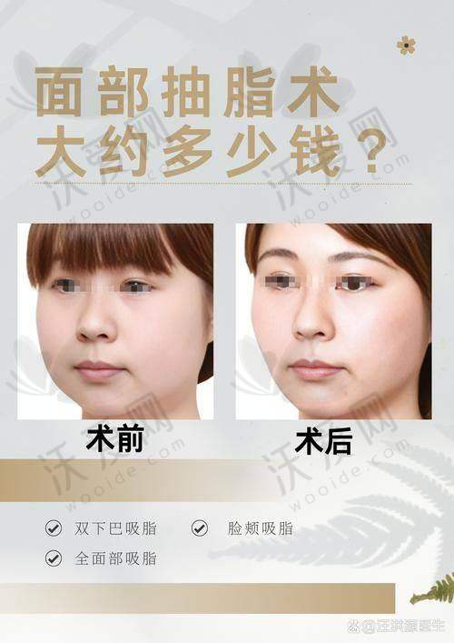 王阔远医生面部减容技术好收费1.5W起，经验多是保护