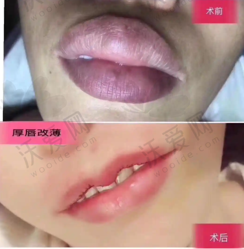 沈阳杏林整形外科医院眼部整形价格
