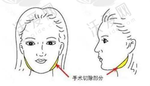 沈阳杏林整形外科医院吸脂及脂肪移植价格