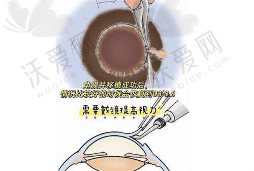 兰州爱尔眼科医院收费价格情况