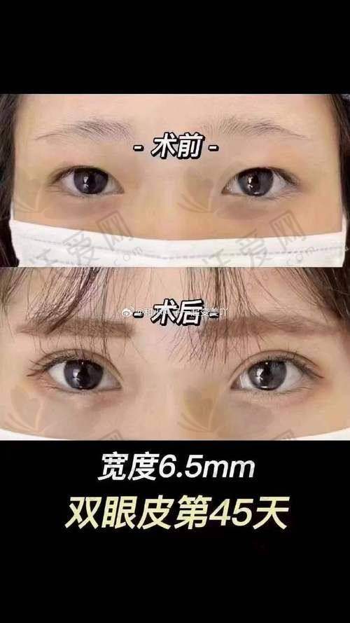 上海张园园医生双眼皮修复价格