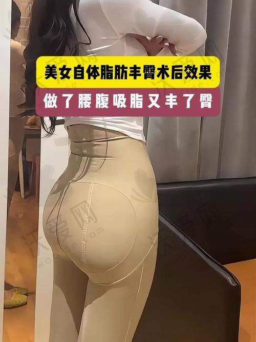 上海首尔丽格自体脂肪丰臀+大腿环吸套餐48900元起，唐鏖、张军利助力打造性感身材曲线